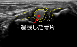 足首の捻挫はなぜ繰り返すのか？